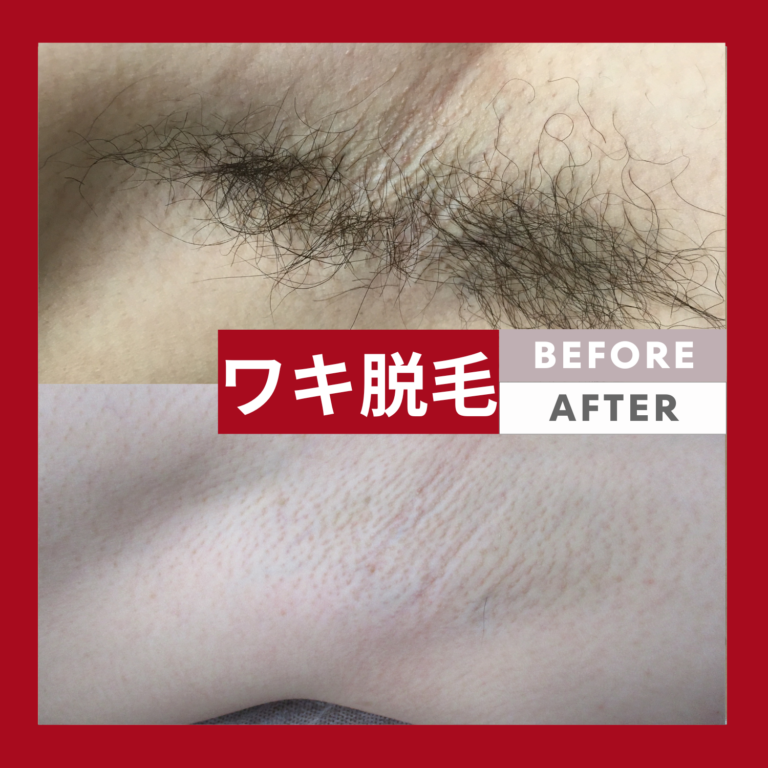 ワキ脱毛の施術前後を比較した写真。上が施術前、下が施術後